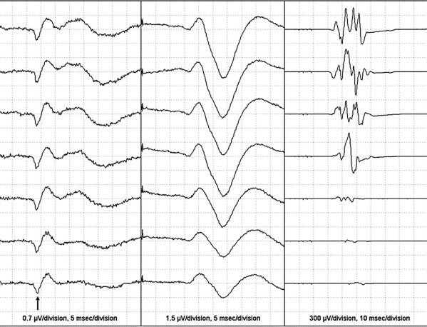 Patient Safety During Transcranial Electrical Motor Evoked Potential-TCEMEP